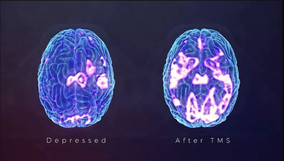 bipolar-disorder