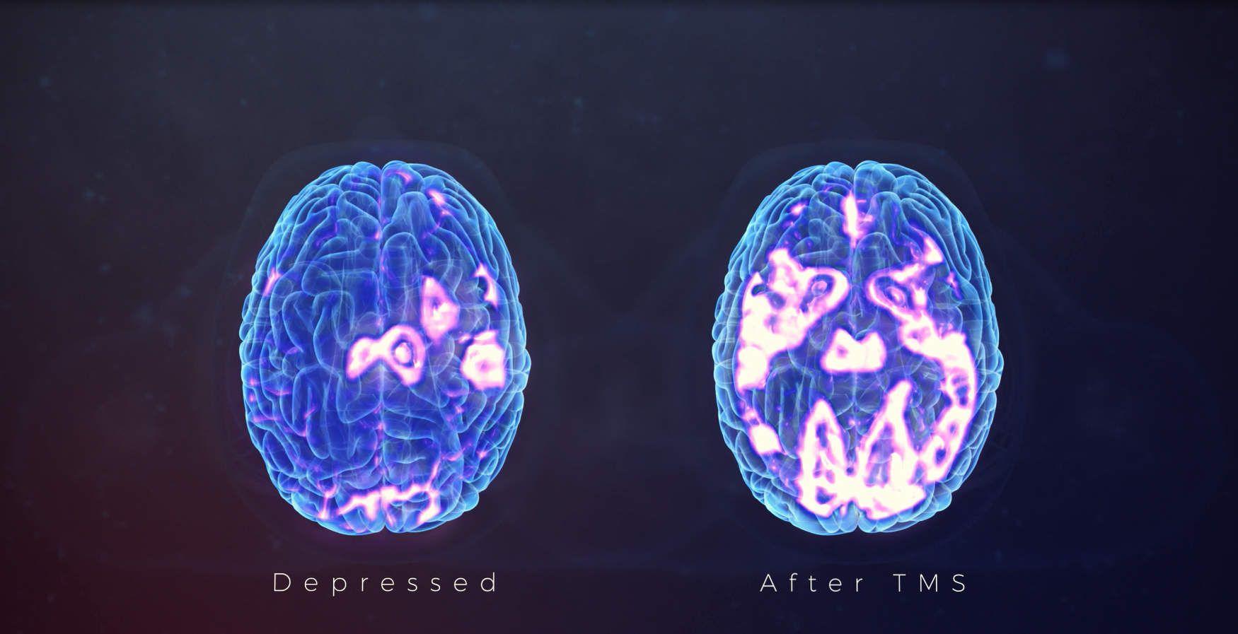 Depressed Brain Vs Normal Brain